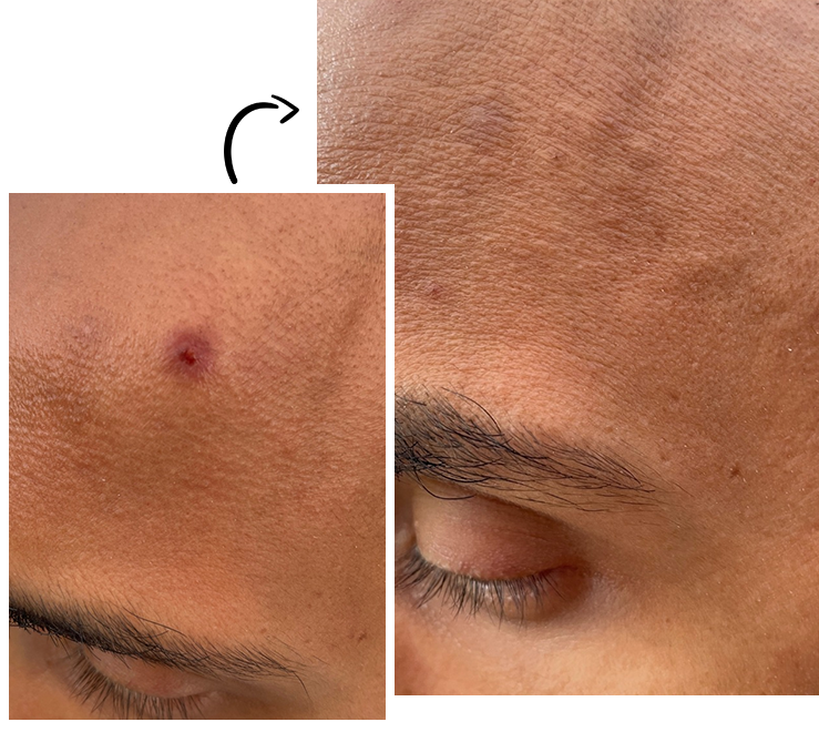 Before and after skin transformation using Plant It On Me’s proven skin-brightening formula